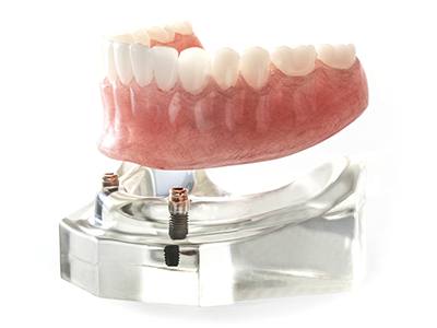 implant-retained denture model