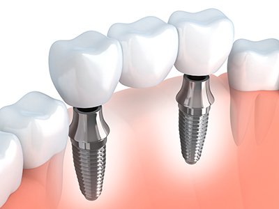 implant-retained dental bridge model
